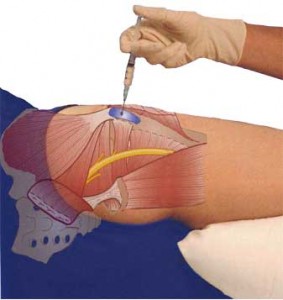 Steroid injection in leg